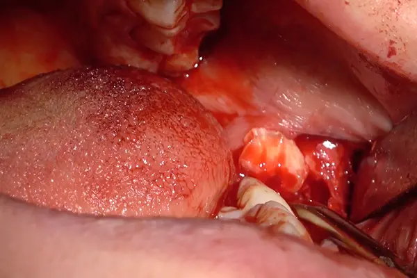 1 to 1 Oral Surgery Training – USA