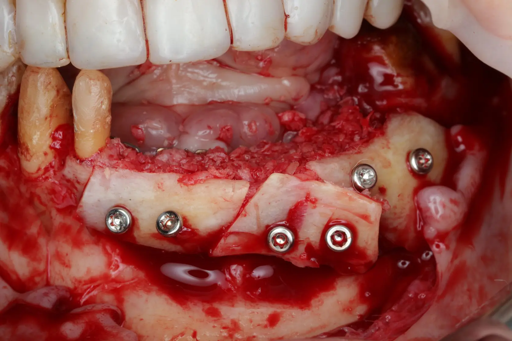 after-oral-reconstruction