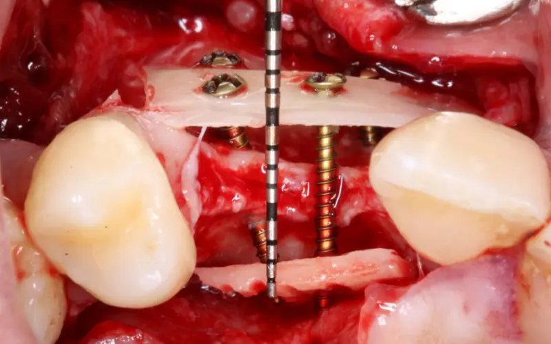 khoury technique